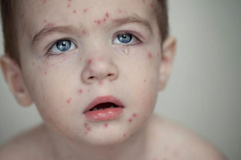Thủy đậu là bệnh khá phổ biến ở trẻ nhỏ